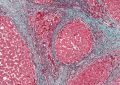 Cirrosis