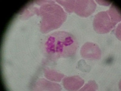 Neutrófilos segmentados bajos