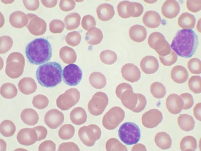 Tipos de enfermedades de linfocitos