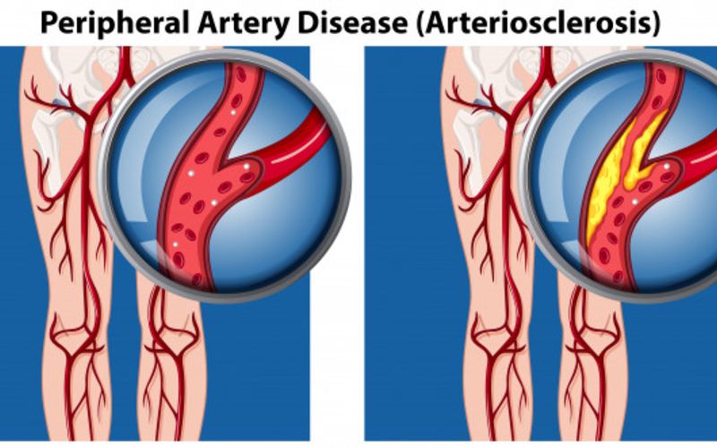 Enfermedad arterial periférica: síntomas y causas