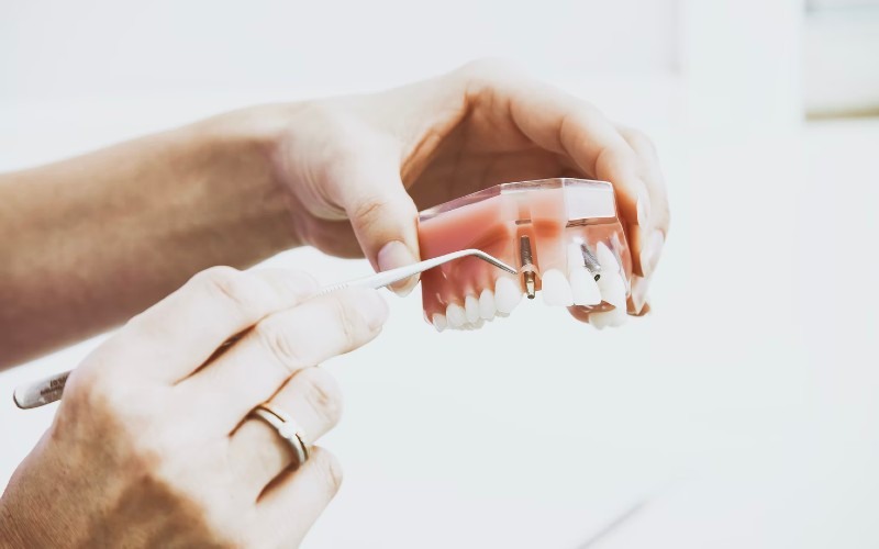 Implantes dentales en Madrid en Salud Dental Blanco