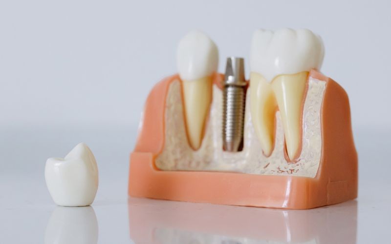 ¿Se pueden poner implantes dentales y dientes en un día o en 24 horas?
